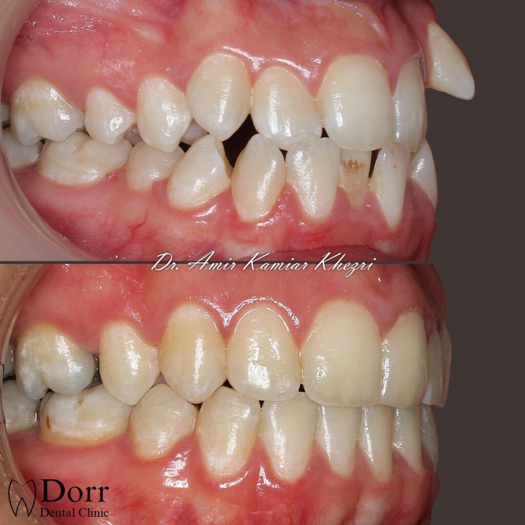 orthodontics-dr-khezri-15-2