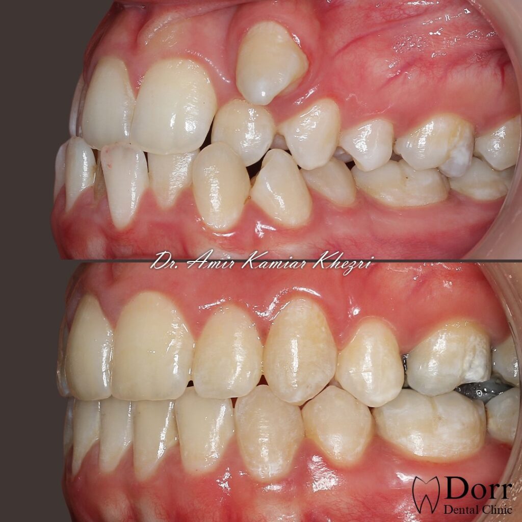 عکس قبل و بعد ارتودنسی دندان های روی هم رفته