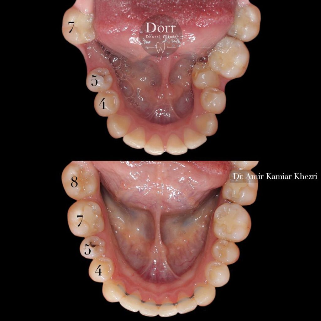 تصویر داخل دهان قبل و بعد از ارتودنسی