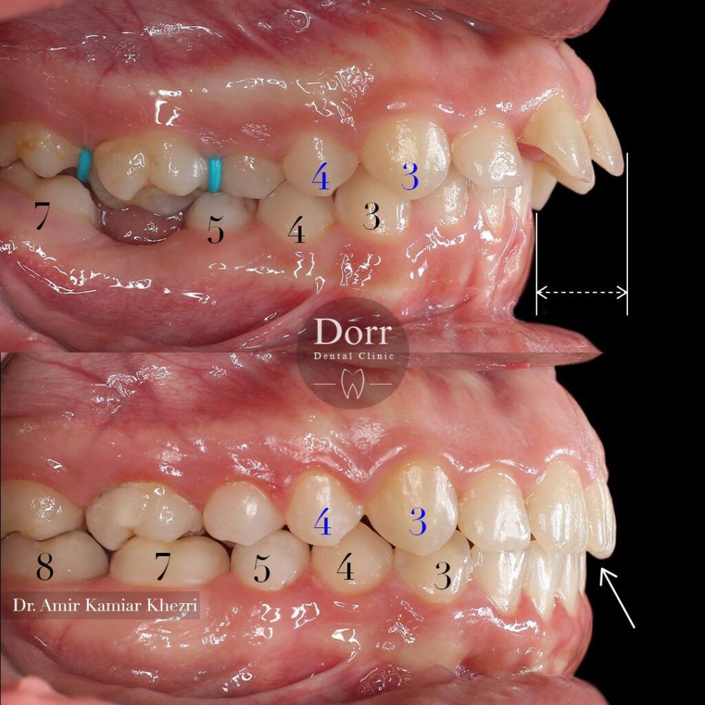 عکس قبل و بعد ارتودنسی دندان های جلو آمده