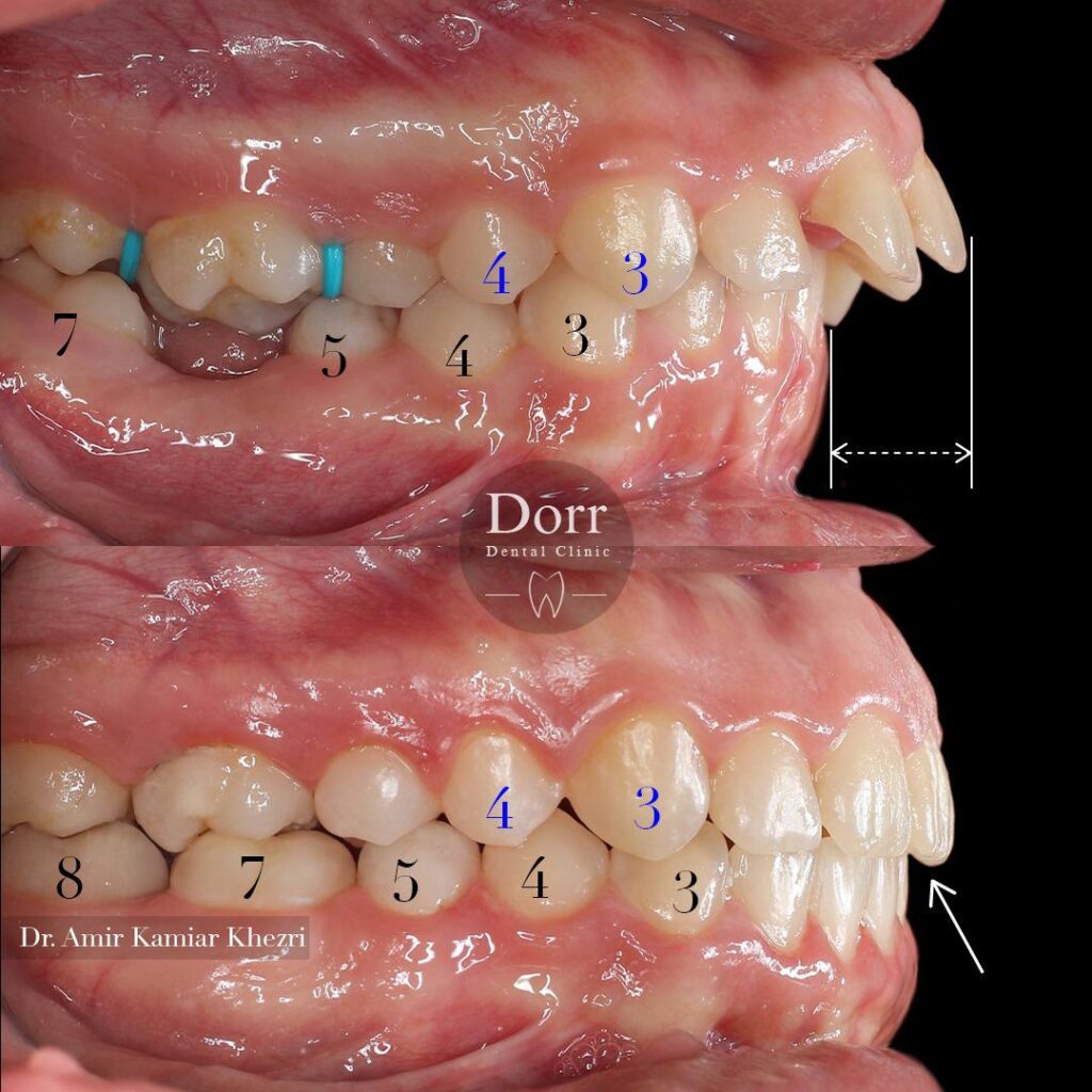 عکس قبل و بعد از ارتودنسی دندان های جلو آمده