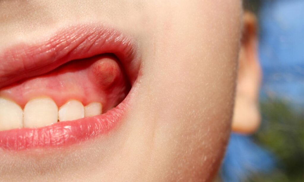 آبسه دندان چیست و چه علائمی دارد