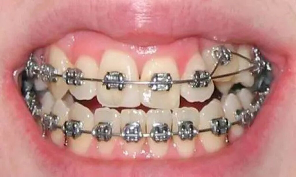 همه چیز درباره ارتودنسی دندان نیش