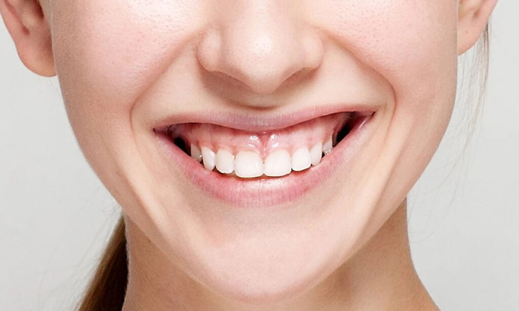 لبخند لثه ای چیست و چه درمانی دارد؟ لبخند لثه ای چیست و چه درمانی دارد؟