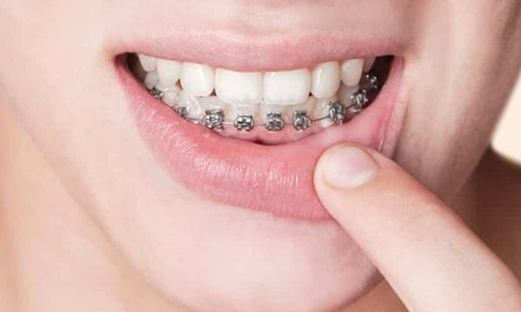 ارتودنسی فک پایین ارتودنسی فک پایین