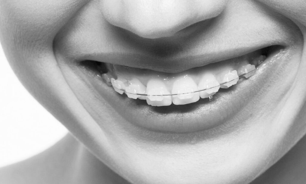 ارتودنسی فک بالا ارتودنسی فک بالا