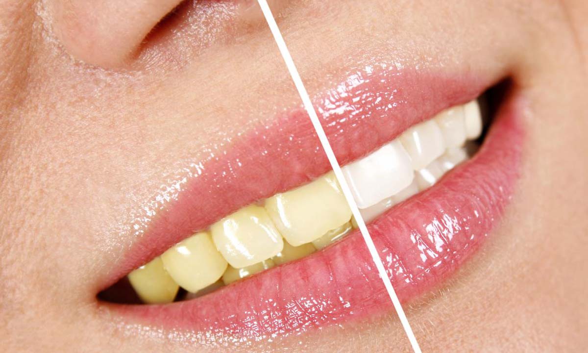 سفید کردن دندان ها پس از ارتودنسی