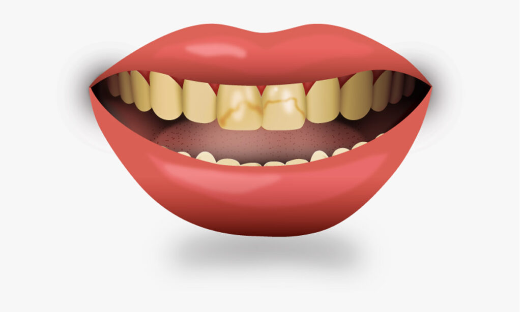 علت زرد شدن دندان ها