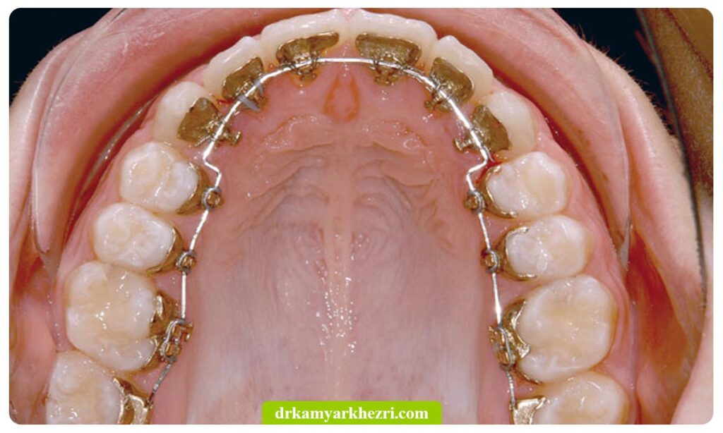 ارتودنسی پشت دندانی یا لینگوال