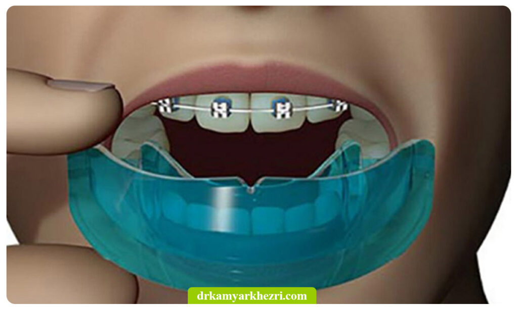 محافظ ارتودنسی دندان