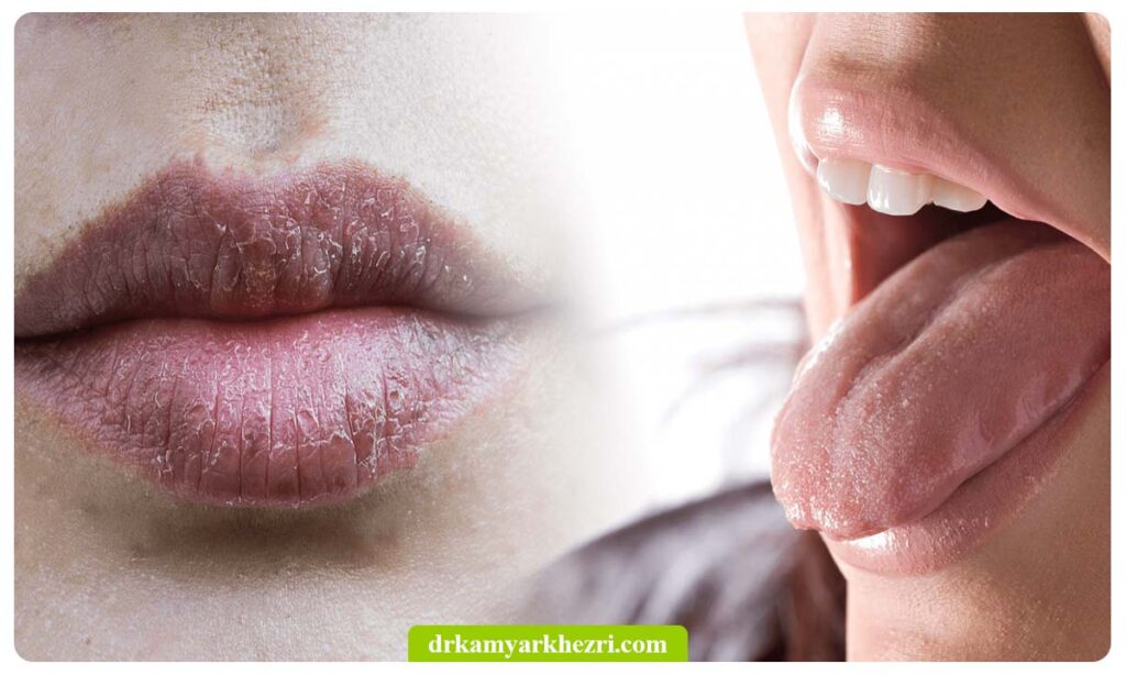 عکس خشکی دهان و لب