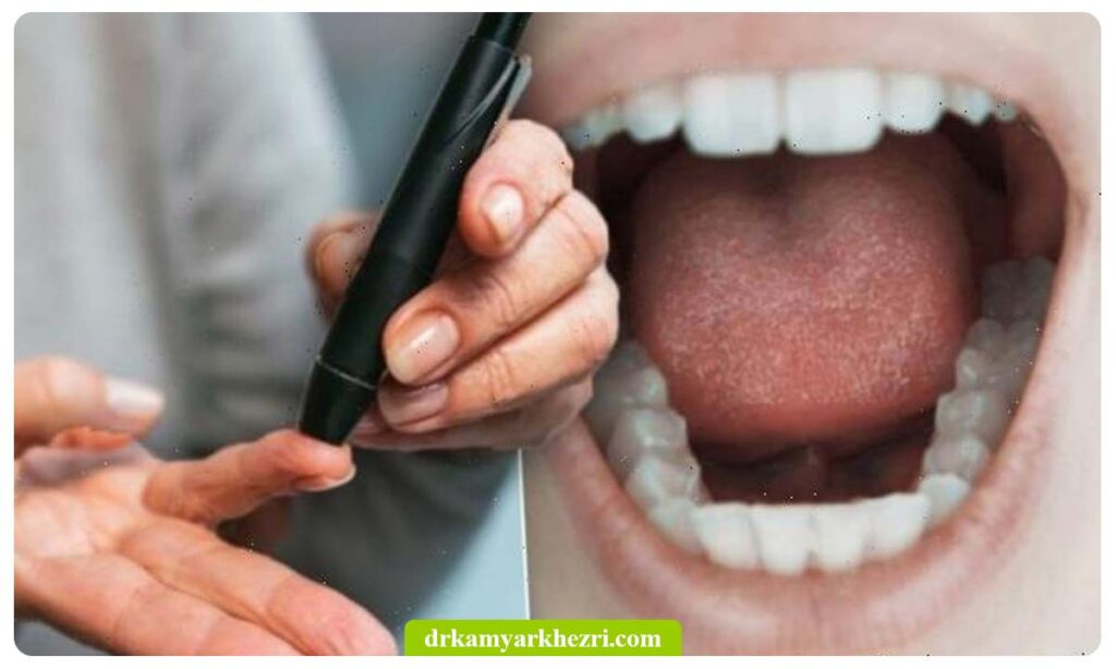 دیابت و خشکی دهان