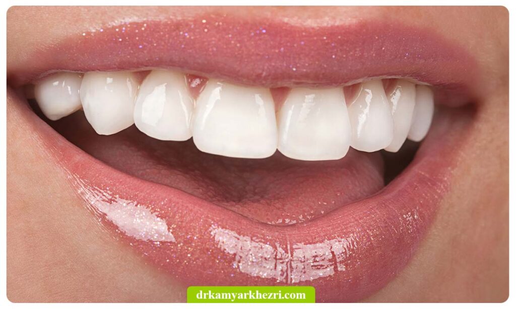 لمینت دندان