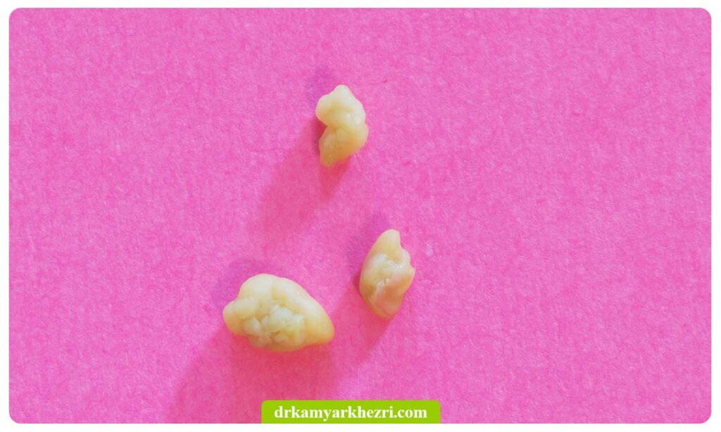 عکس سنگ لوزه بزرگ و کوچک