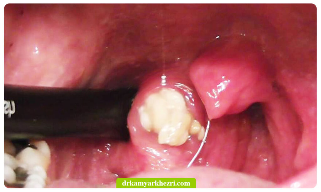 عکس سنگ لوزه در دهان
