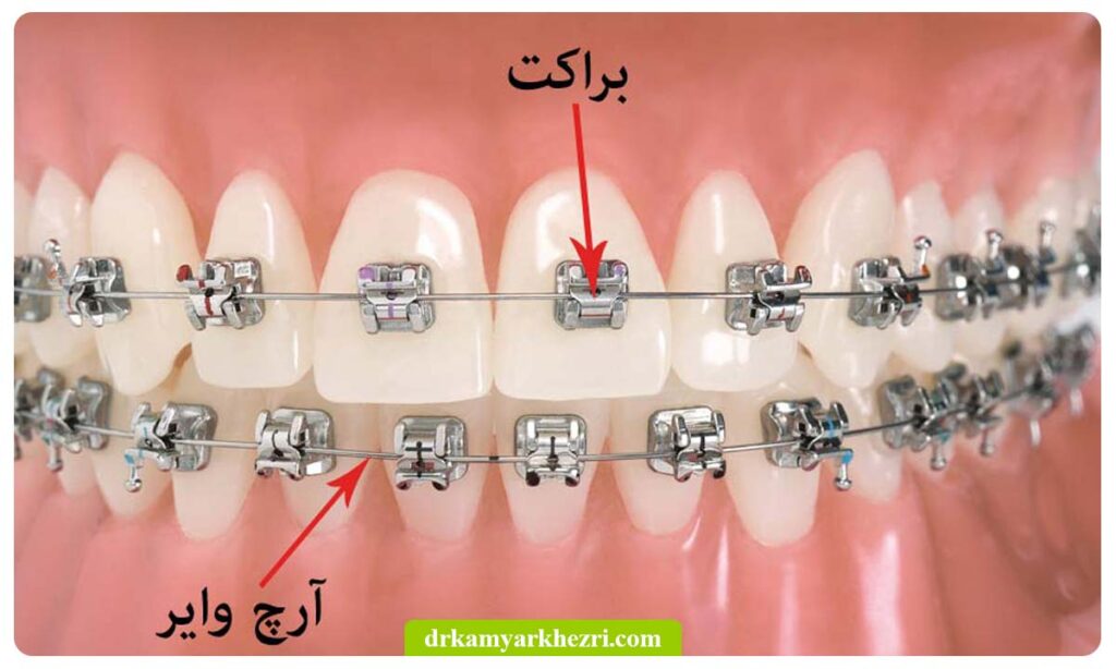 براکت و سیم ارتودنسی