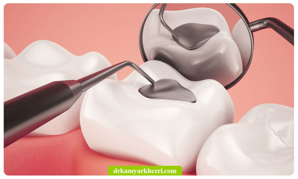 پوسیدگی دندان