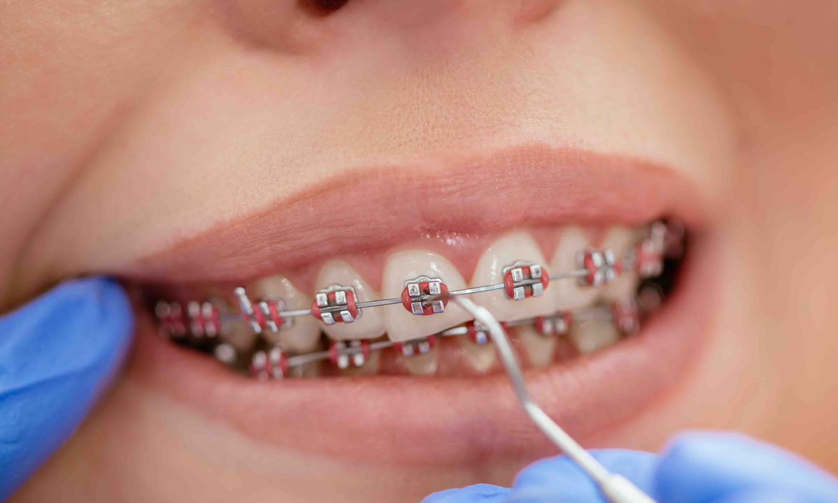 ارتودنسی دندان های حساس